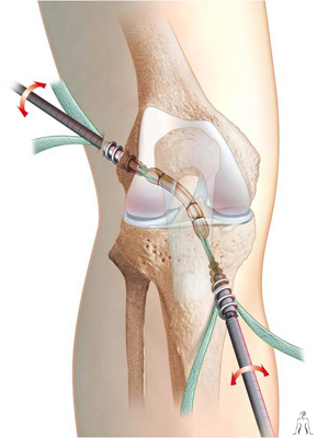 Orthopedic surgery in Tunisia - cruciate ligament surgery
