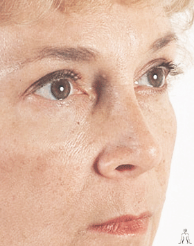 blepharoplasty