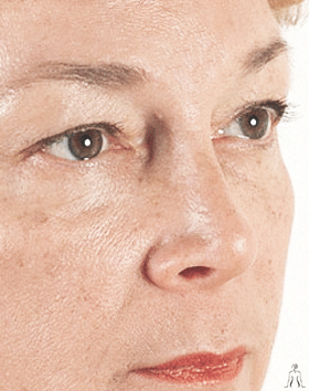 blepharoplasty