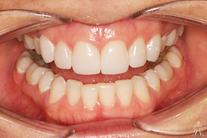 Dental surgery Dental Implant in Tunisia
