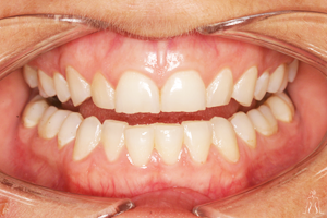 Dental surgery Dental Implant in Tunisia