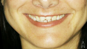 Dental Surgery in Tunisia - Dental Veneers