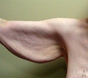 Cosmetic Surgery in Tunisia - Arm Lift