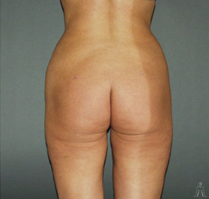 Cosmetic Surgery in Tunisia - Thigh lift