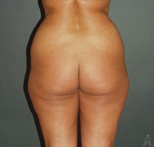 Cosmetic Surgery in Tunisia - Thigh lift