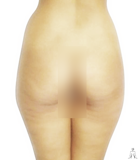 Liposuction Cosmetic Surgery in Tunisia