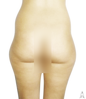 Liposuction Cosmetic Surgery in Tunisia