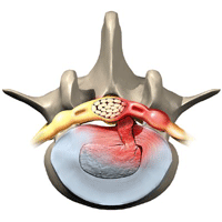 Orthopedic surgery in Tunisia - lumbar disc