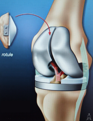 Orthopedic surgery in Tunisia - Knee prosthesis